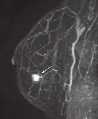 reast Cancer Molecular Subtye and MRI has become a widely used surrogate for breast cancer subtying [14 18].