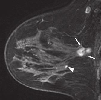 The urose of our study was to examine whether these markers can be used to select the atients who may benefit the most from reoerative breast MRI.