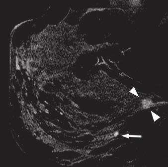 registered atients who underwent reoerative breast MRI and had tumors classifiable into molecular subtyes and had MRI findings that could be aroriately categorized.