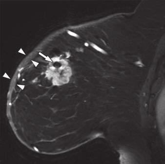 Ha et al. fined as at least one enlarged axillary lymh node with athologic confirmation of metastasis by either reoerative core biosy or final surgical athologic examination.