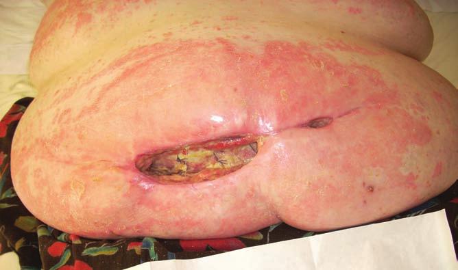 CASE REPORT 3 This 52-year-old female was admitted to an acute surgical ward for re-laparotomy and removal of exisiting mesh from an old hernia repair site in 2006.