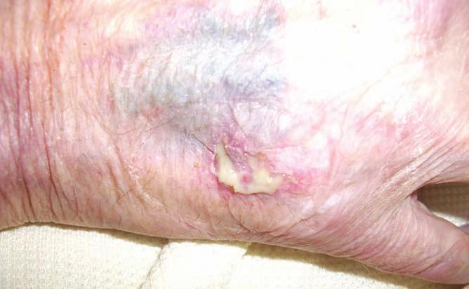 Tegaderm absorbent being peeled back. Conclusion The use of any adhesive dressing on elderly, friable skin is always a risk.
