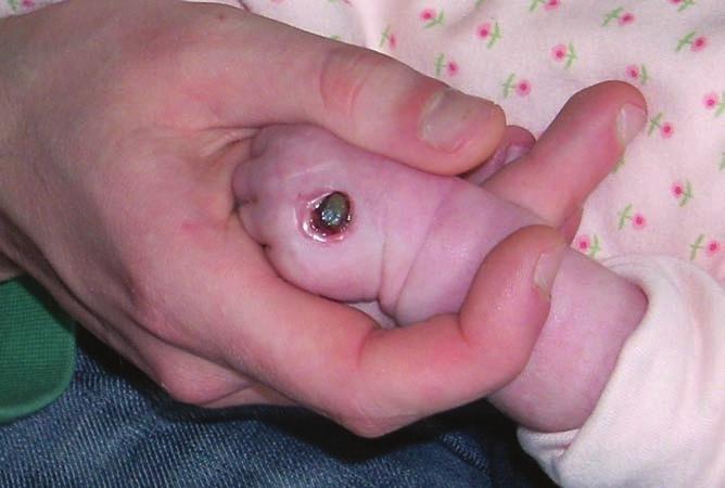 CASE REPORT 6 A 16-day-old female baby with a history of epilepsy presented with a chemical burn to the back of her left hand.