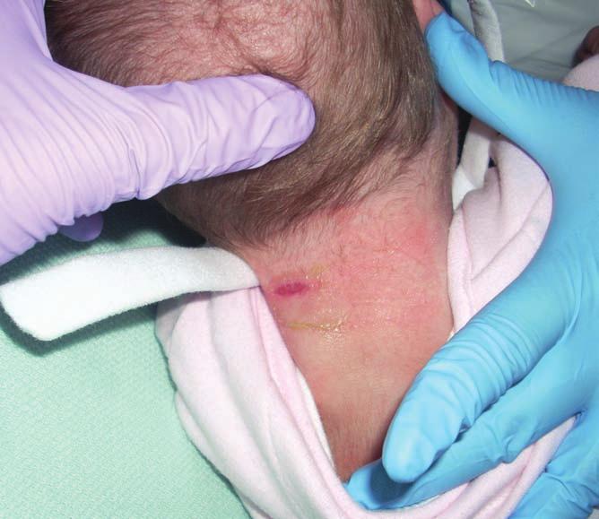 CASE REPORT 8 This case report discusses the use of Appeel Sterile sachet (CliniMed) in the removal of adhesive dressings in a paediatric setting.