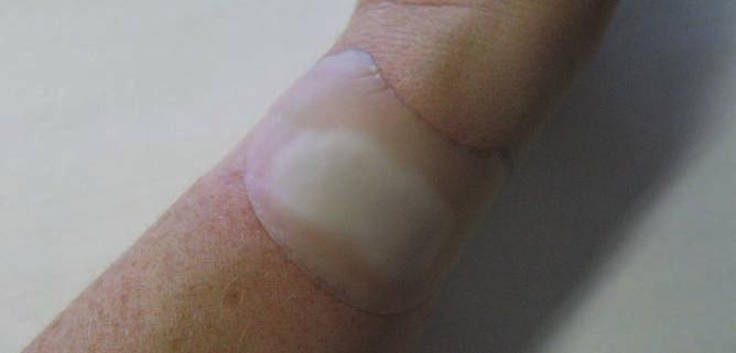 CASE REPORT 9 A 40-year-old female presented to the tissue viability department with a small, painful chemical burn to her right wrist.