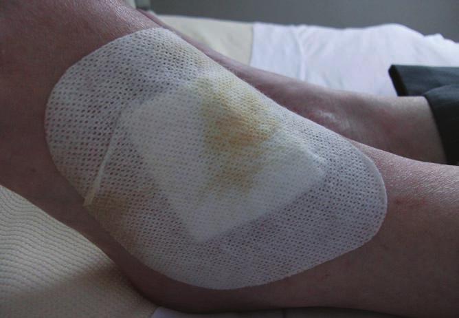 CASE REPORT 1 In this case, following staff referral, a 50-year-old female presented to the department of tissue viability with a wound to the dorsal aspect of the left foot.