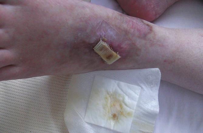 CASE REPORT 1 cont. Appeel Sterile sachet (CliniMed Ltd, Bucks, UK) was applied to the top edge of the dressing (Figure 2) and then in steady drops around the edge to facilitate removal (Figure 3).