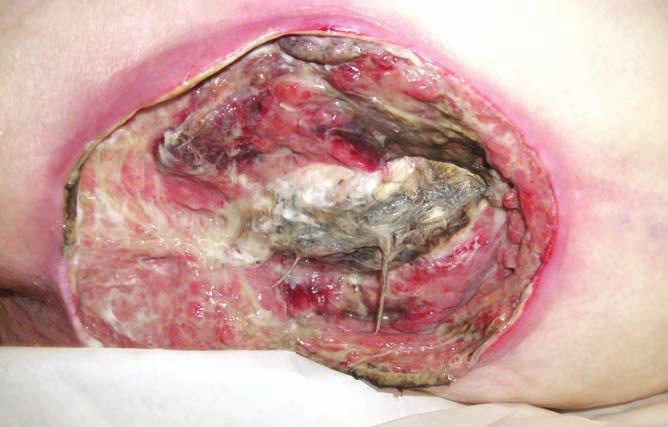 CASE REPORT 2 cont. Autolytic debridement of the wound continued over two weeks through dressing intervention (Figures 3 and 4).