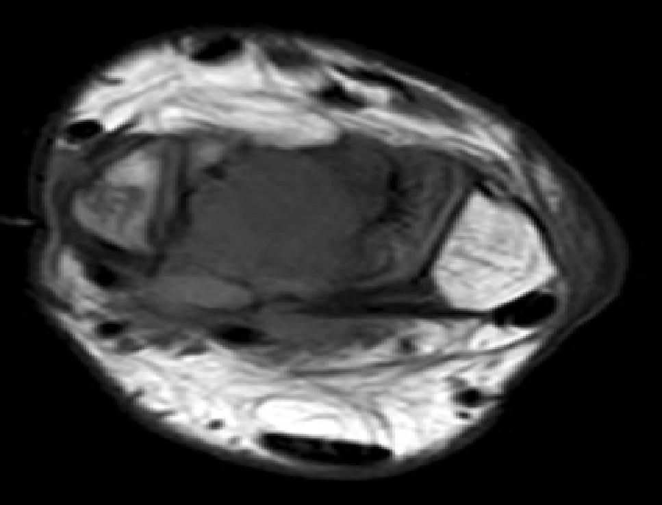 Contrast enhanced MRI done from our clinic showed a bubbly, lytic, solid cum cystic mass lesion with multiple trabeculations involving the body, neck and tail of the talus.