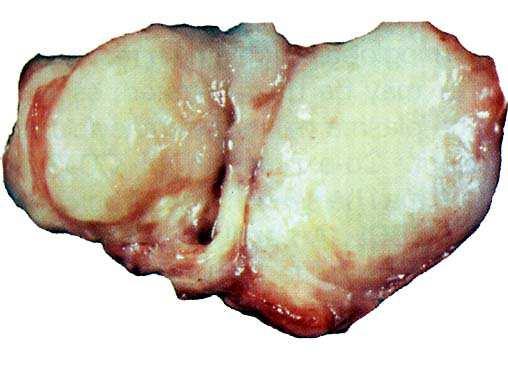 Primary thyroid gland lymphoma Up to 20 cm in largest diameter Cut surface smooth, pale tan, white-gray or red, fleshy
