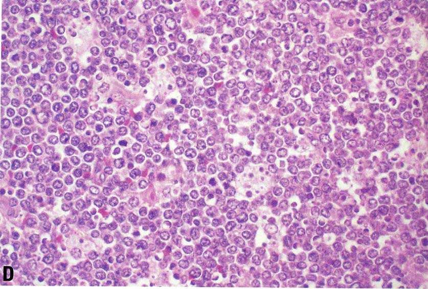 Differential diagnosis Large B-cell lymphoma versus carcinoma (primary undifferentiated carcinoma of the thyroid), metastatic