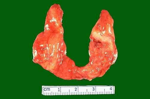 Atrophic thyroid gland in a hypothyroid