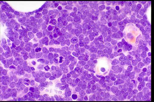 Double hit lymphoma DHL is a genotype associated with a very poor prognosis in various B-cell neoplasms Lymphomas with double-hit genotype: Burkitt or Burkitt-like lymphoma (most common)