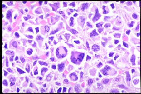 Old (2008): Anaplastic large cell lymphoma (ALCL) Angioimmunoblastic