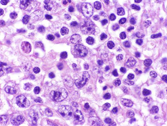 Anaplastic large cell lymphoma (ALCL), ALK+ and ALK- Nodal TCLs with TFH
