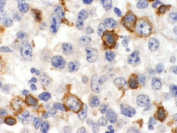 Histopathology 64:171; 2014 Large T-cell lymphoma most common in children
