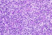 often sinusoidal growth pattern CD3 ALK Angioimmunoblastic T-cell lymphoma