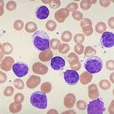 Mature B-cell Lymphomas Chronic Lymphocytic Leukemia/Small Lymphocytic Lymphoma & Monoclonal B-Cell Lymphocytosis Old (2008): Monoclonal B-cell lymphocytosis (MBL) Monoclonal B-cells in PB <5K/µL*