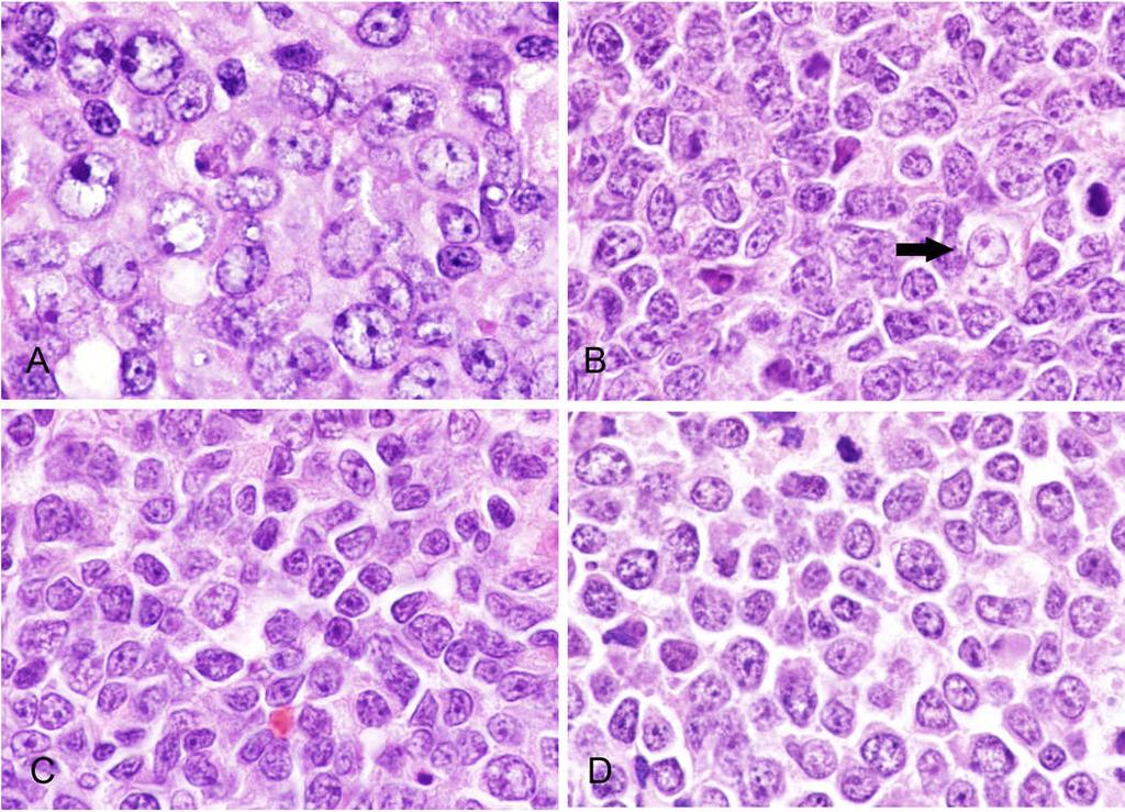 Old (2008): Follicular lymphoma, grades 1, 2, 3A, & 3B Follicular Lymphoma New (2016): Follicular lymphoma, grades 1, 2, 3A, & 3B Follicular lymphoma, pediatric type Large B-cell lymphoma with IRF4