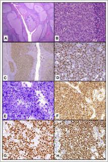 Large B-cell lymphoma with rearrangement of IRF4 (MUM1) Liu et al. Am J Surg Pathol 37: 333; 2013 Salsverria et al.