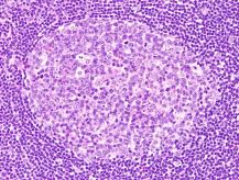 Burkitt Lymphoma Typical immunophenotype: CD20 + CD10 + BCL6 + BCL2 - CD10 Burkitt Lymphoma Genotype: Most