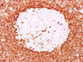 Haematologica 100:e275; 2015 Resemble typical Burkitt lymphoma morphologically, immunophenotypically, and