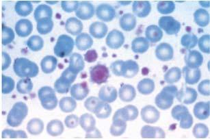 giant platelets