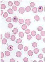 target cells acanthocytes