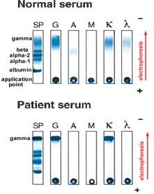 PCR assay for clonality: VDJ gene rearrangement