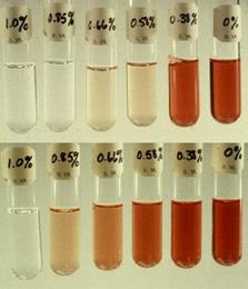 Osmotic fragility test Sickle cell