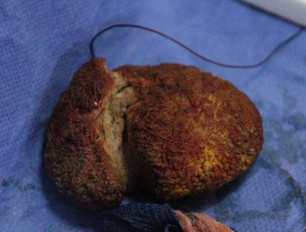 Sponge left within the bladder in patient with separate