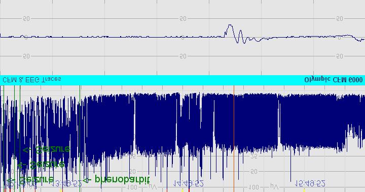 14 Sample 11: CFM amplitude becomes moderately abnormal following phenobarbitone. EEG shows severe discontinuity.