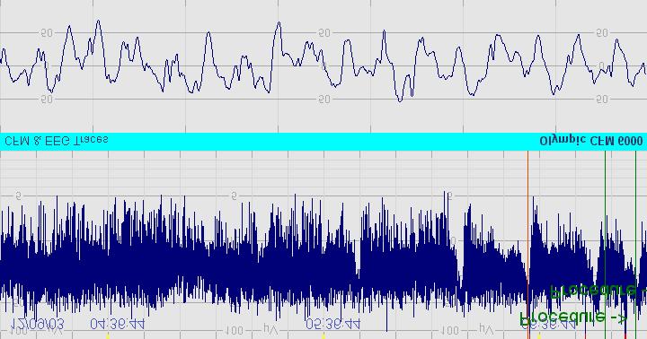 16 Sample 15: Normal CFM amplitude but seizures are
