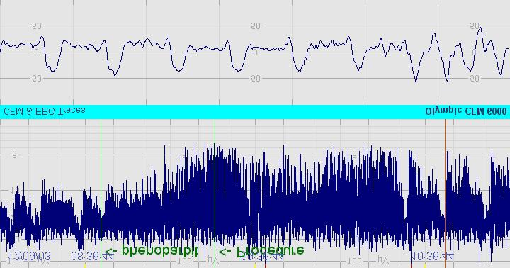 Sample 16: CFM shows seizures which are confirmed