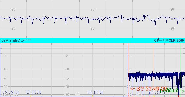 19 Sample 21: Only ECG artefact detected in this trace.