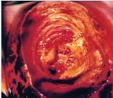 7: Excision of ectocervical plus endocervical lesions (a)