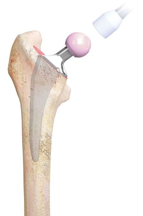Surgical Technique Femoral Head Impaction Following the final trial reduction, clean and dry the femoral stem taper to ensure it is free of debris.
