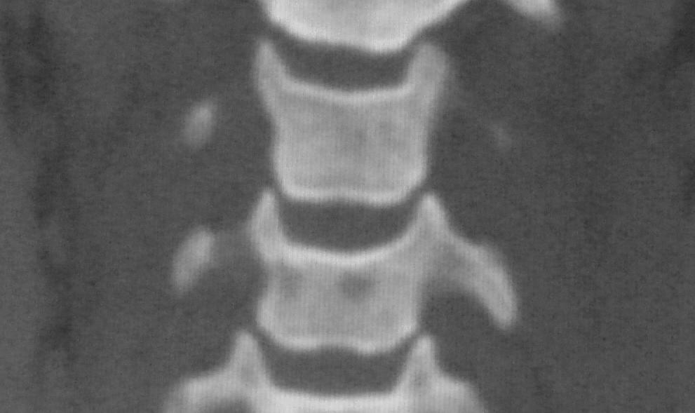 1052-1060 Figure 3: Coronal reconstructed CT