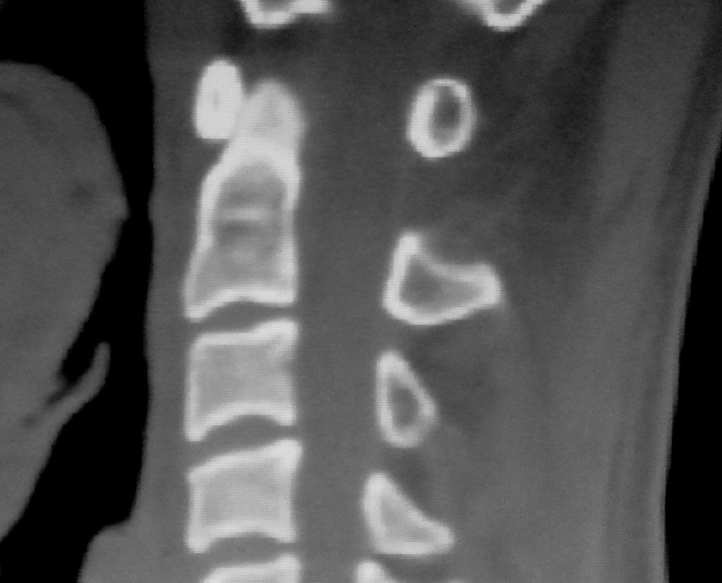 image showing fracture of dens (Type 2).