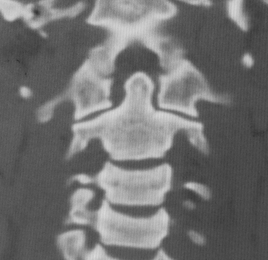 vertebra (Figure 5a).