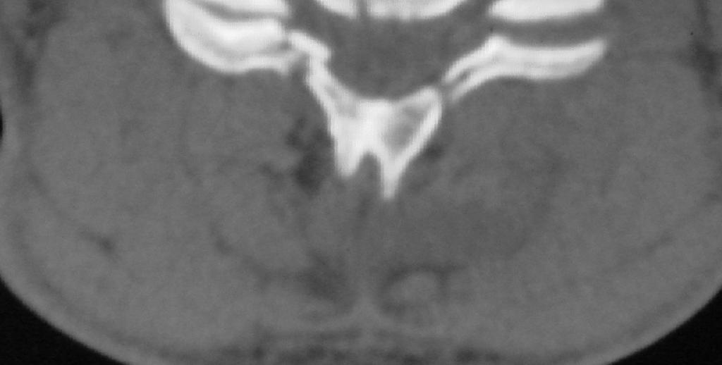 Figure 7: Axial CT image showing fracture of