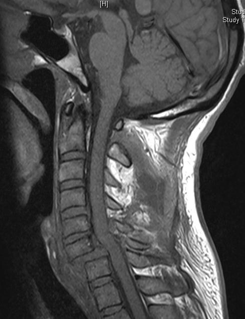 MR Imaging Excellent soft tissue detail To detect spinal cord integrity/