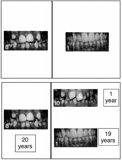 ORTHODONTIC UTILITY VALUES 301 Figure 1 values. The pictures used to calculate the subjects utility Visual analogue scale A VAS 200 mm long using anchor points of AC scores 1 and 10 was constructed.