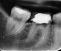 PROCEDURAL COMPLICATIONS Separated Instrument Case One Tooth #30 exhibiting