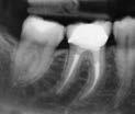 palatal canal of tooth #4.