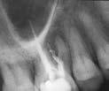 PROCEDURAL COMPLICATIONS Perforations Case One Tooth #3 exhibiting a coronal perforation.