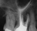 Recall Perforations Case Two Tooth #30 with previous retreatment attempt resulting in furcal