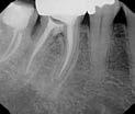 Recall TREATMENT CONSIDERATIONS/PROGNOSIS > Perforations-Location Apical with no sulcular