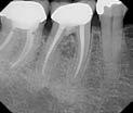 defect Apical, crestal or furcal with sulcular communication and a probing defect with osseous