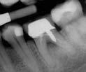PROCEDURAL COMPLICATIONS Post Perforations Case One Tooth #27 with sinus
